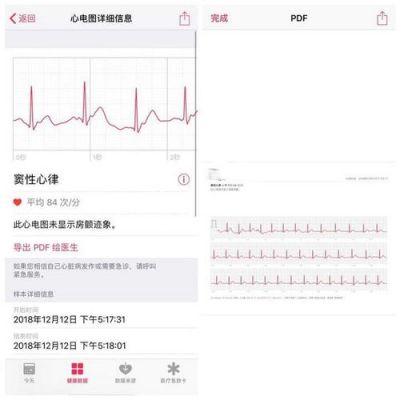 国行怎么激活ECG心电图（国内如何激活ecg）-图3